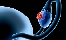 Estudio molecular para el tratamiento del cáncer de ovario