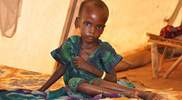3,1 millones de niños menores de cinco años mueren cada año en África por desnutrición
