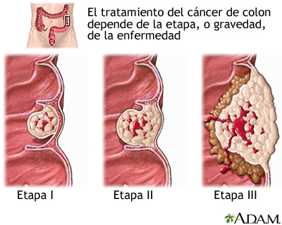 El Cáncer de Colon es perfectamente curable