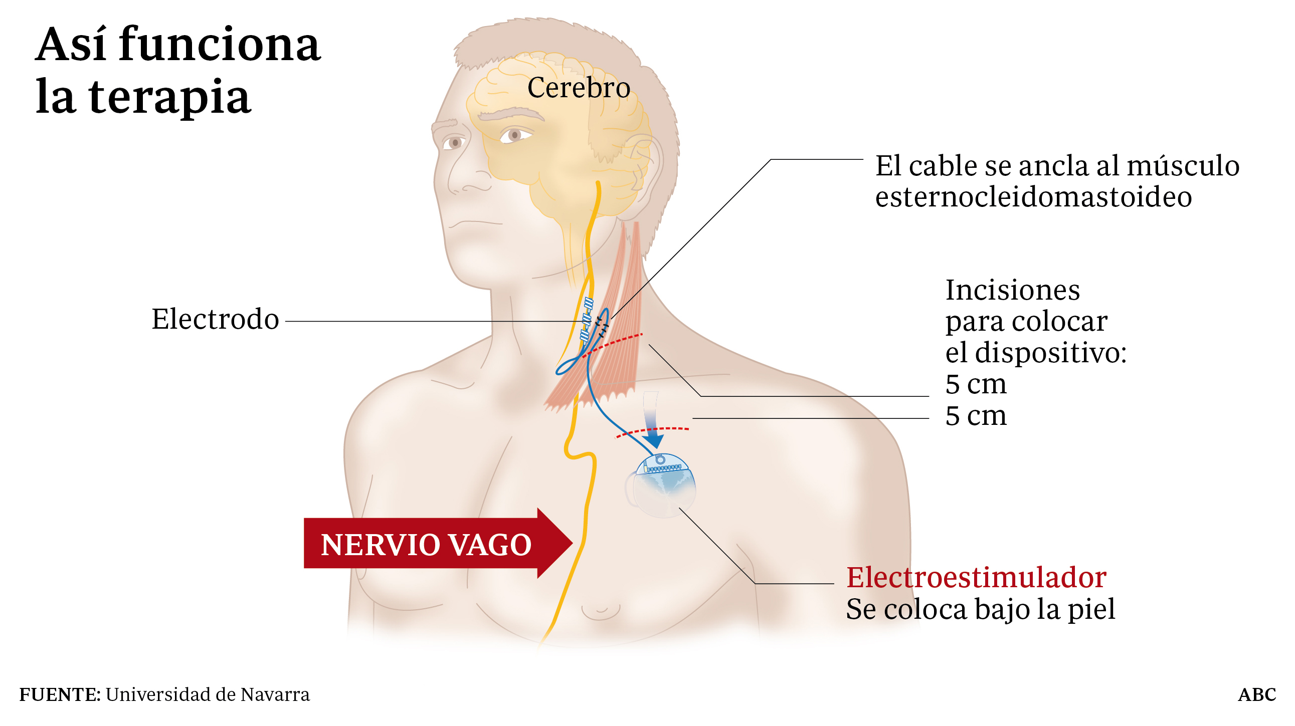 Un hombre que llevaba 15 años en estado vegetativo despierta a consecuencia de una terapia innovadora Un hombre que llevaba 15 años en estado vegetativo despierta a consecuencia de una terapia innovadora