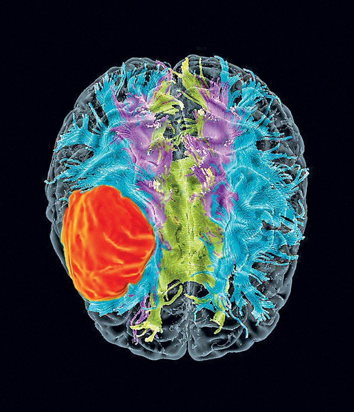 Nuevas terapias biológicas para los tumores cerebrales